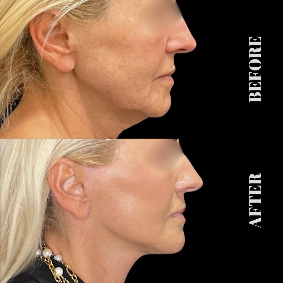 Результаты до и после Deep Plane Facelift в Artisan Clinic, видимое омоложение лица