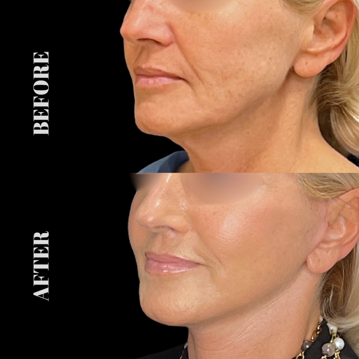 Resultados antes y después de Deep Plane Facelift en Artisan Clinic, rejuvenecimiento facial visible