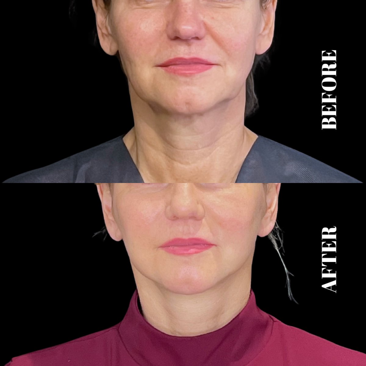 Результати до та після Deep Plane Facelift в Artisan Clinic, помітне омолодження обличчя