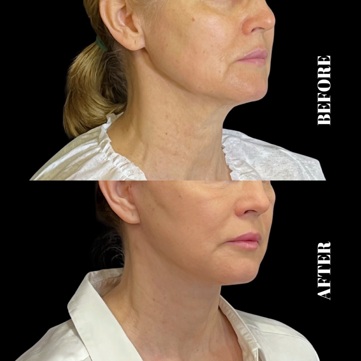 Результати до і після Deep Plane Facelift в Artisan Clinic, помітне омолодження обличчя