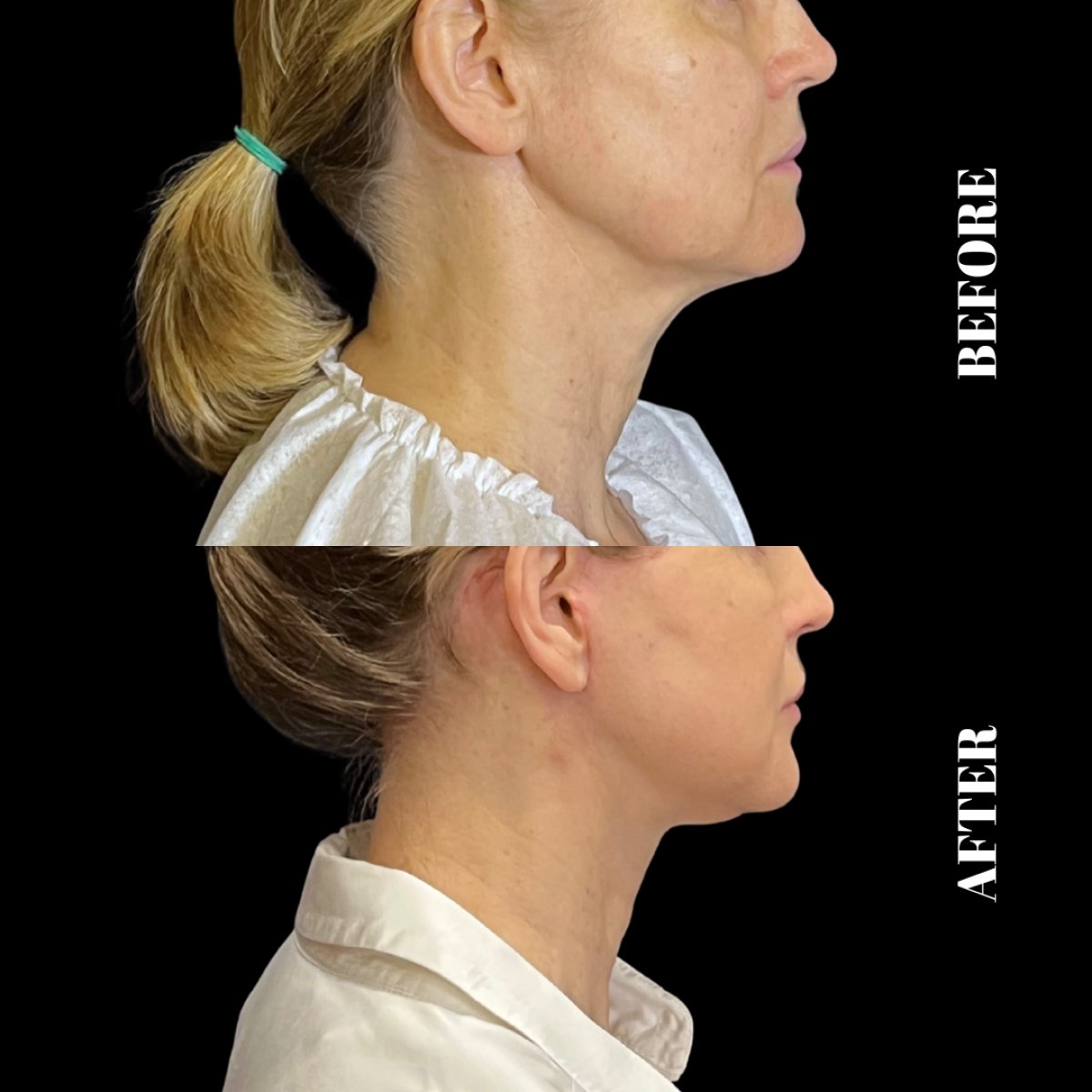Résultat avant/après lifting deep plane à Artisan Clinic, ovale du visage et cou raffermis