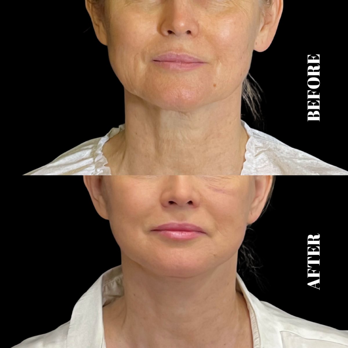 Résultats avant/après lifting Deep Plane à Artisan Clinic, rajeunissement facial visible