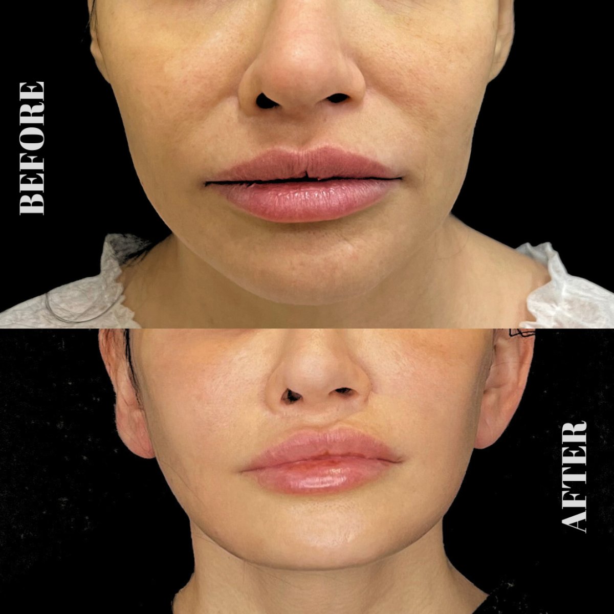 Resultados antes y después de Deep Plane Facelift en Artisan Clinic, rejuvenecimiento facial visible
