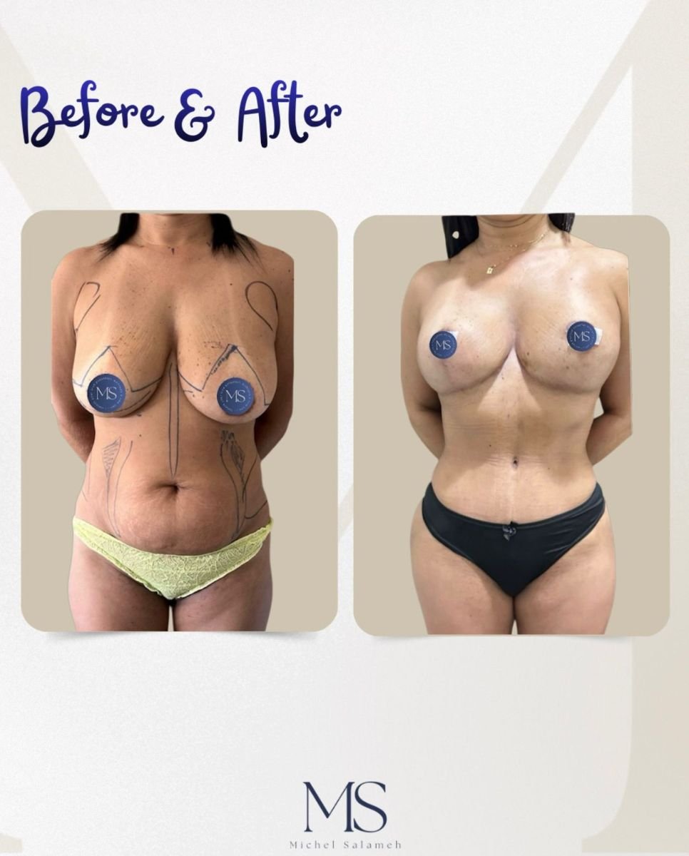 Resultados de mommy makeover antes y después en Michel Salameh Clinic – contorno corporal y mamario