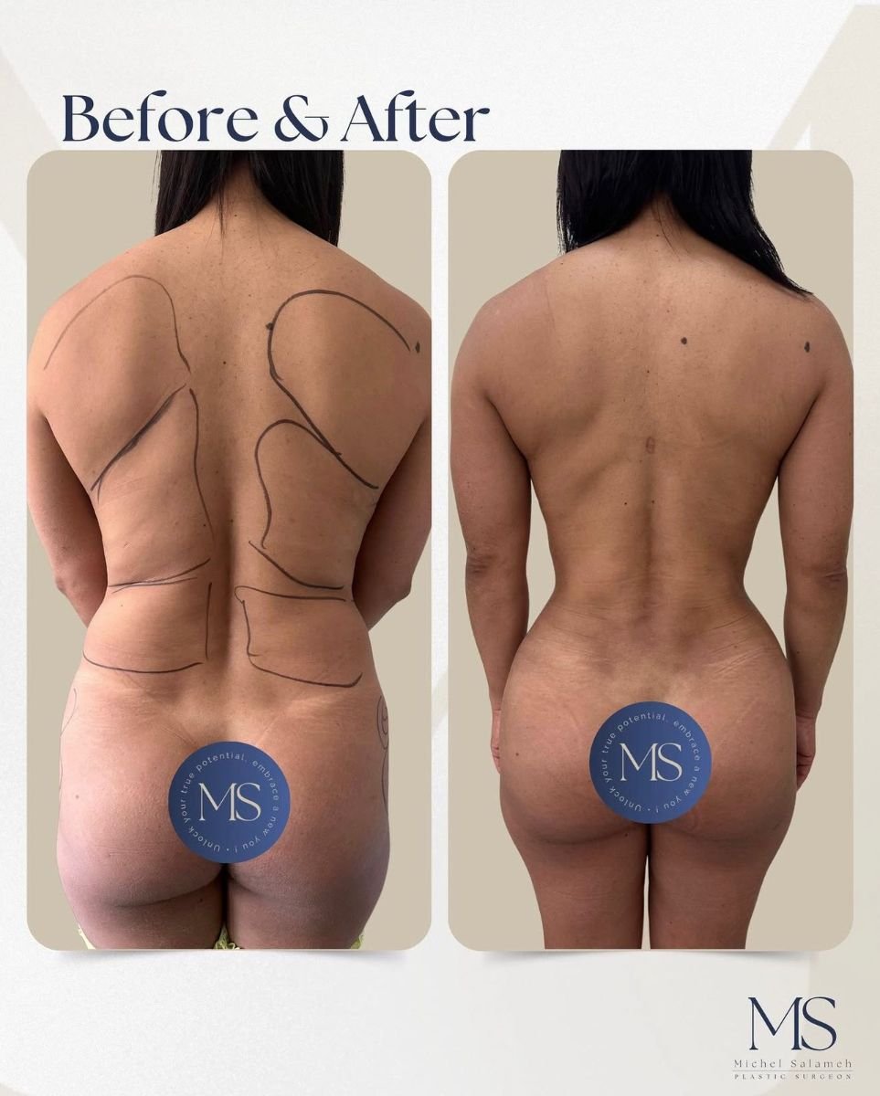 Mommy makeover before and after results at MS Clinic – visible body contour improvement