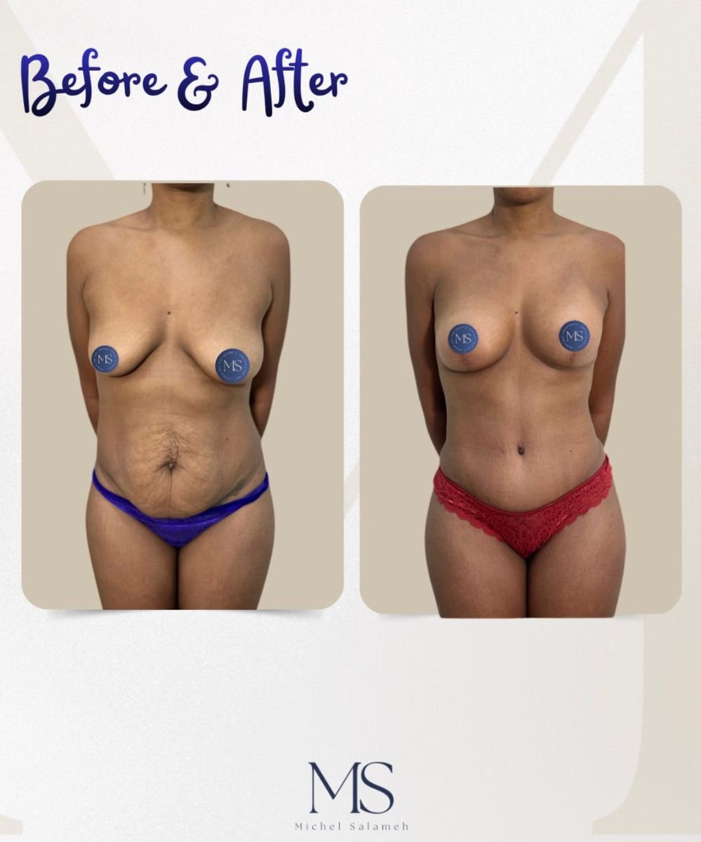 Mommy makeover before and after results at Michel Salameh Clinic – body and breast contouring