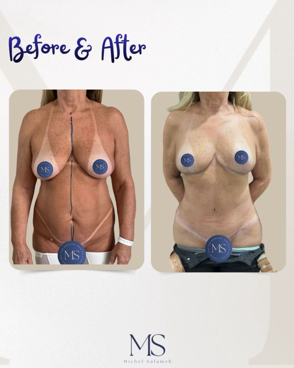 Mommy makeover before and after results at Michel Salameh Clinic – body contour improvement