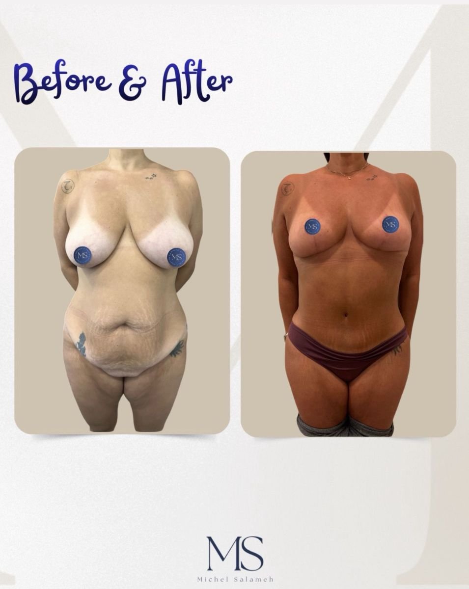 Resultados de mommy makeover antes y después en Michel Salameh Clinic – mejora corporal
