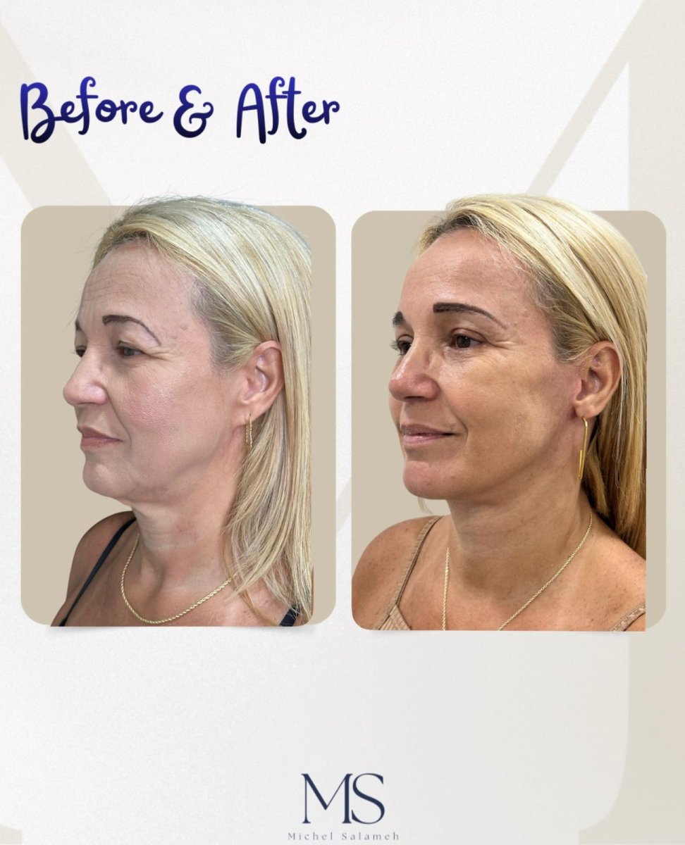 Resultados antes y después de deep plane facelift en Michel Salameh Clinic, rejuvenecimiento facial