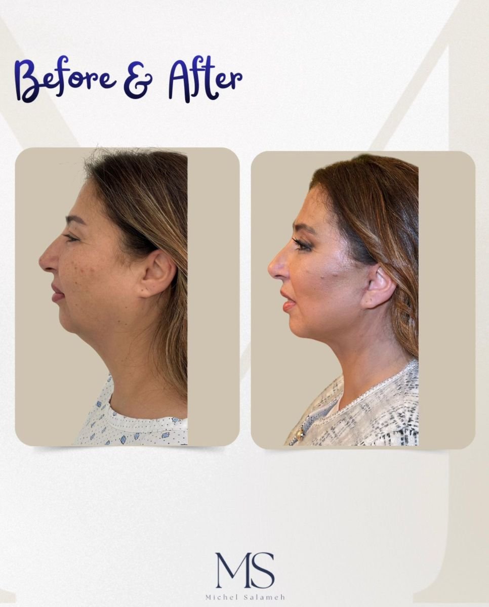 Результаты до и после deep plane facelift в клинике Michel Salameh, видимый лифтинг лица