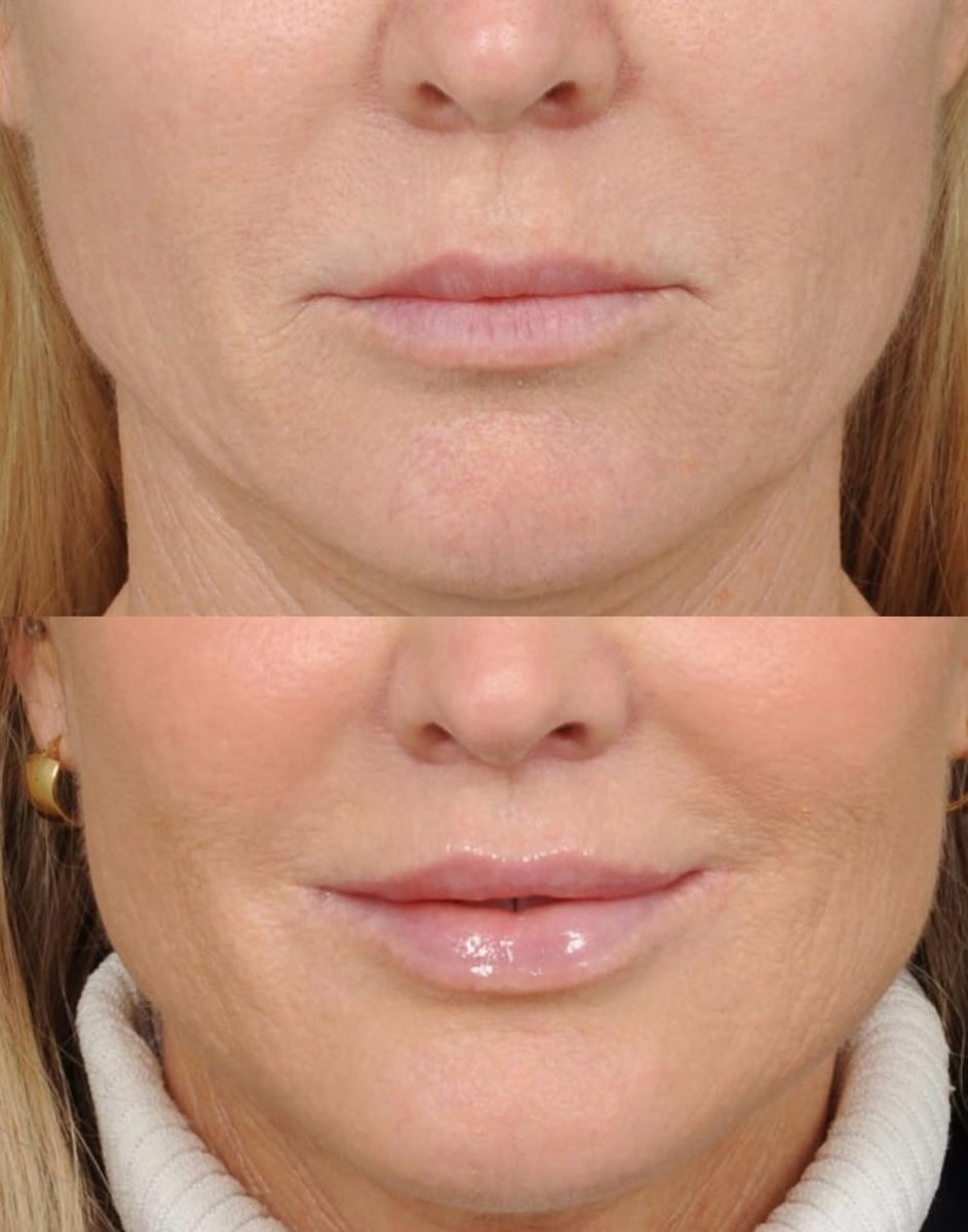 Resultados antes y después de lip lift en Dr. Alexandro Aguilera - Plastic Surgery, contorno mejorado