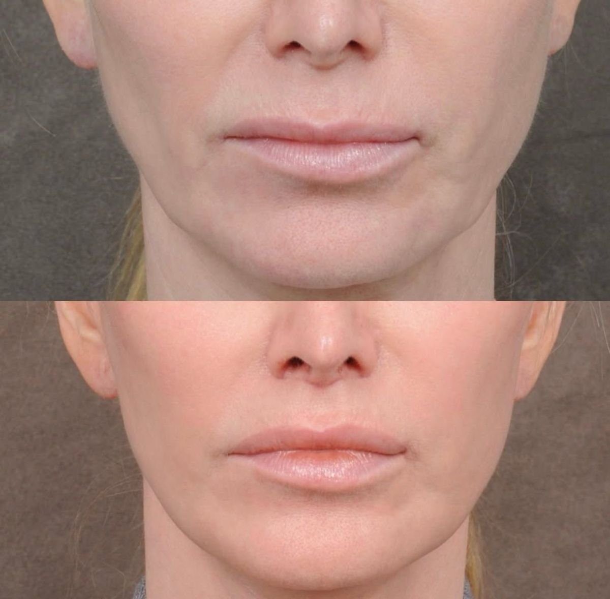 Resultados antes y después de lip lift en Dr. Alexandro Aguilera - Plastic Surgery, contorno labial mejorado