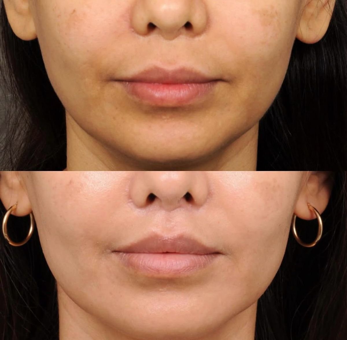 Résultats avant/après lip lift chez Dr. Alexandro Aguilera - Plastic Surgery, contour des lèvres amélioré