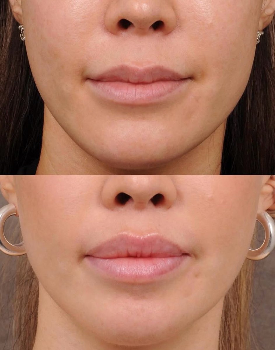 Before and after lip lift results at Dr. Alexandro Aguilera - Plastic Surgery, enhanced lip contour