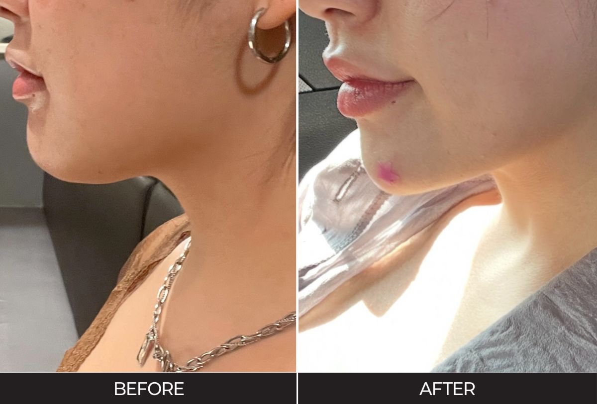 Before and after Botox injections at Forena Clinic, visible chin and jawline contouring result