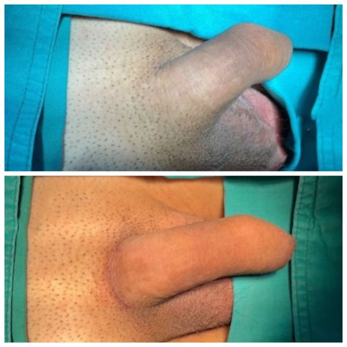 Before and after Selective Dorsal Neurotomy (SDN) surgery results at Eternity Clinic Pleonchit