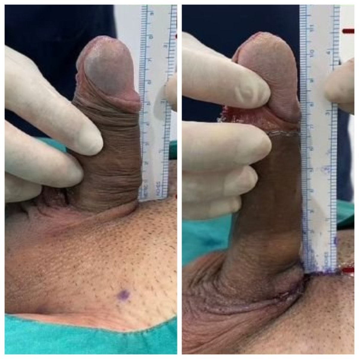 Результаты увеличения пениса до и после в Eternity Clinic Phuket By Dr.Beer, видимое удлинение
