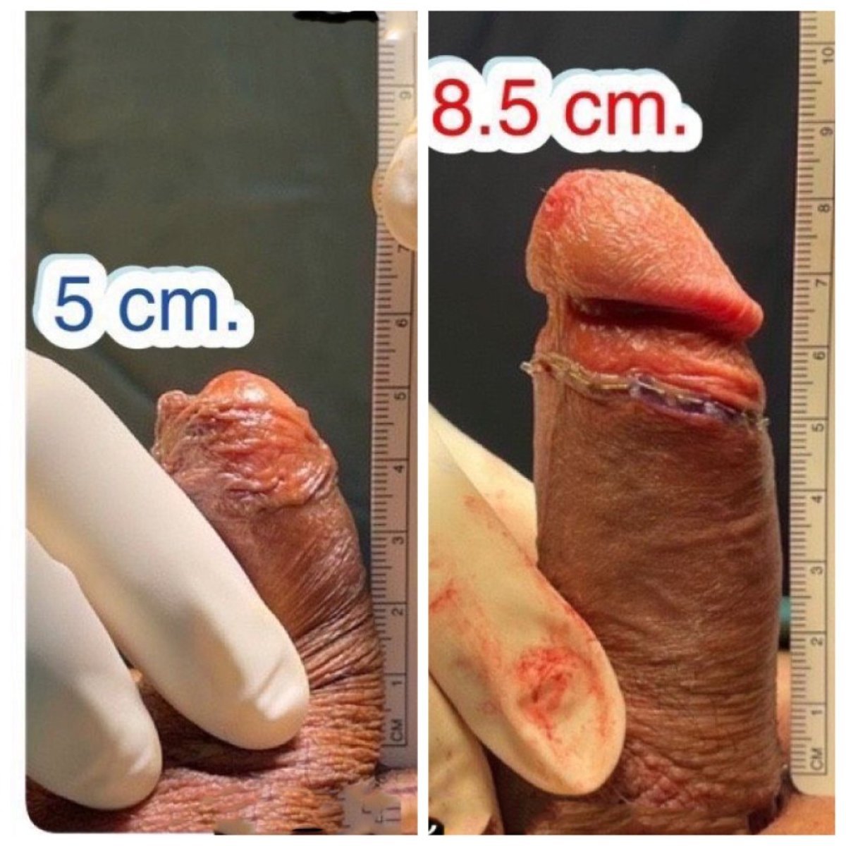 نتائج تكبير القضيب قبل وبعد في Eternity Clinic Phuket By Dr.Beer، زيادة الطول