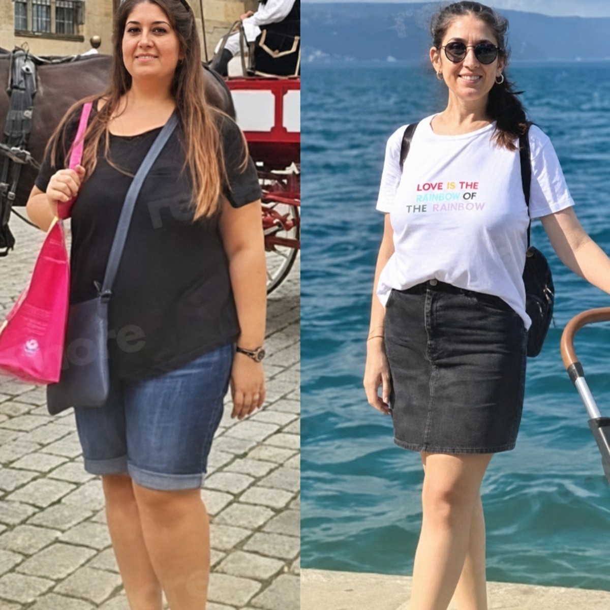Antes y después de resección de estómago en Memorial Göztepe Hospital, notable pérdida de peso