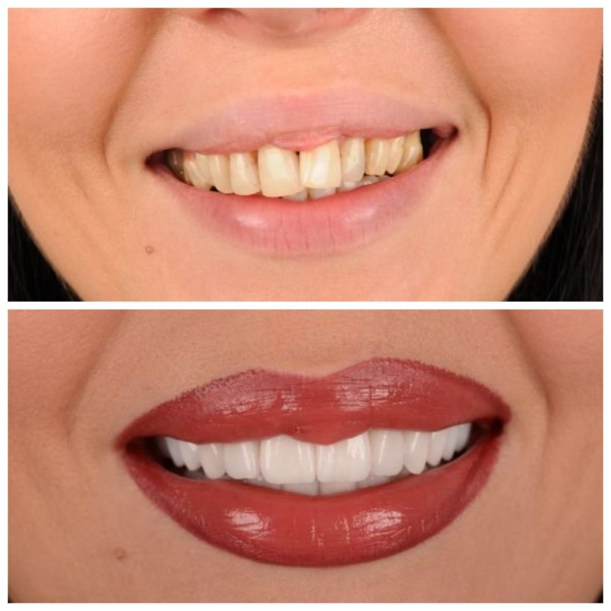 Before and after veneers at RIKOTA Dental Clinic – smile transformation and whiter teeth result