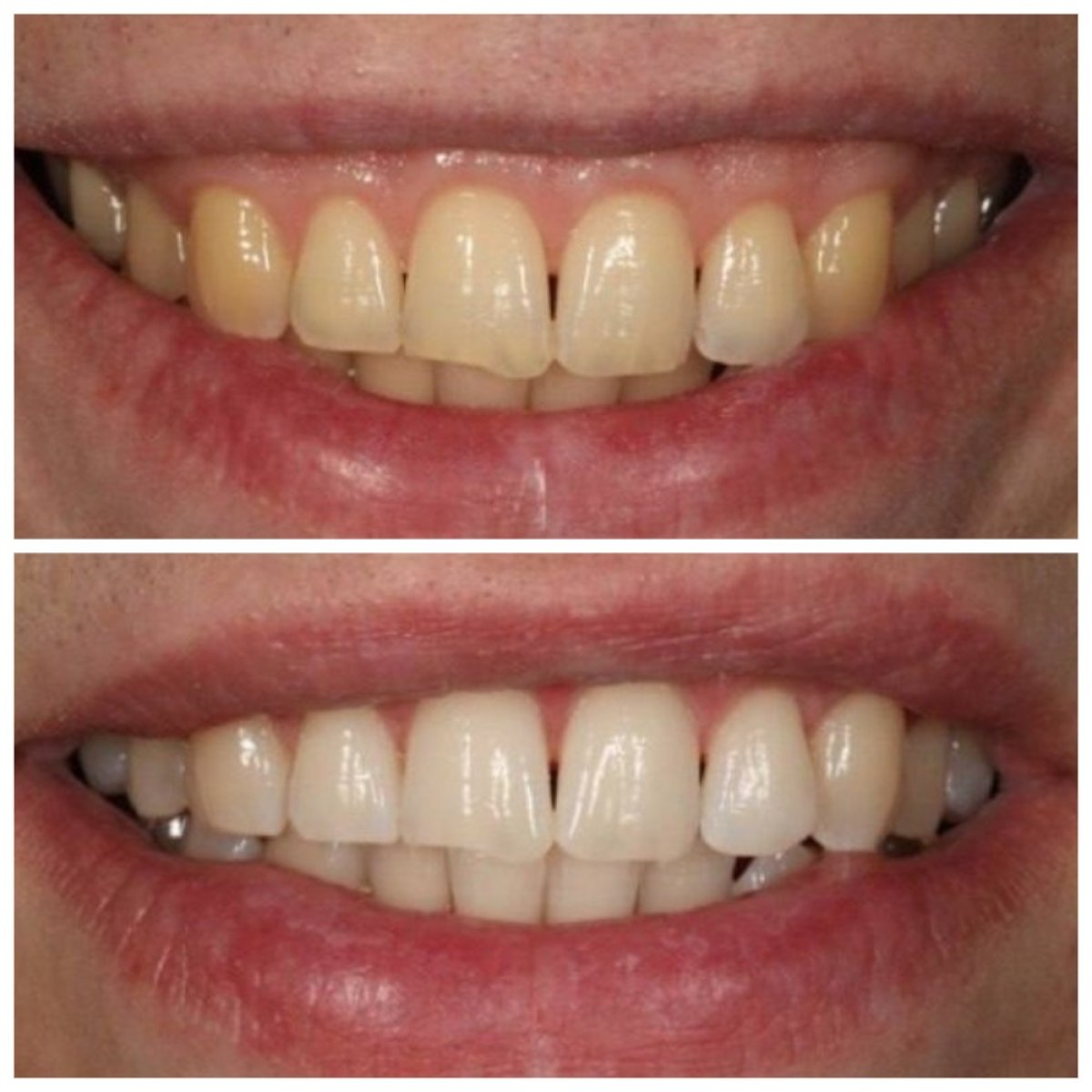 نتائج تبييض الأسنان قبل وبعد في RIKOTA Dental Clinic – ابتسامة أكثر إشراقًا