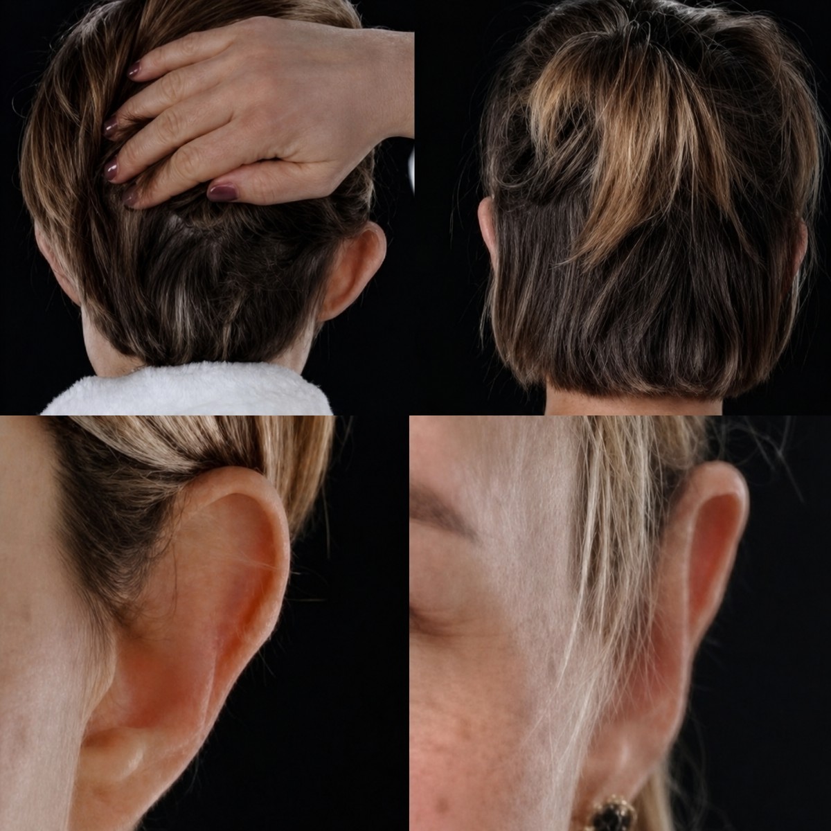 Resultados de otoplastia antes y después en Yurchenko Plastic Surgery Team, cirugía de orejas