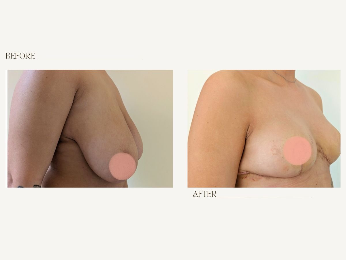 Before and after breast reduction results at InSense Clinic (SV Plastic Surgery Clinic)