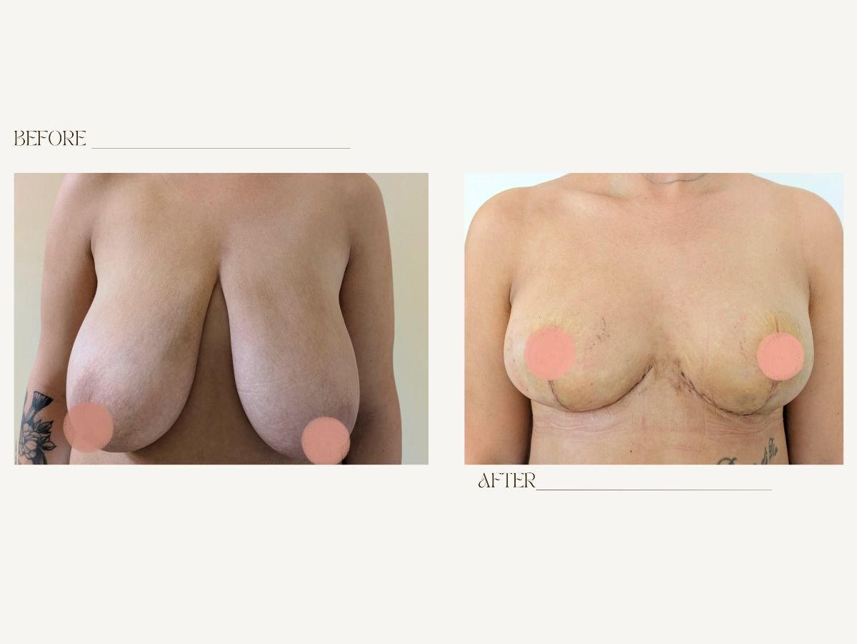Before and after breast reduction results at InSense Clinic (SV Plastic Surgery Clinic)