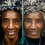 Before and after Blepharoplasty (Eyelid correction) photos by Dr. 