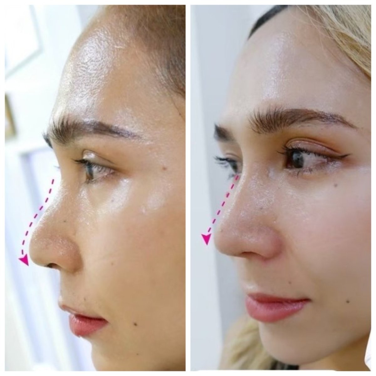Resultados antes y después de alarplastia en Somchai Clinic, remodelación nasal