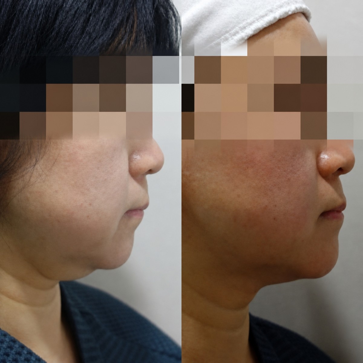 Efekty przed i po botoksie w Lalian Cheongdam Clinic, widoczny kontur linii żuchwy