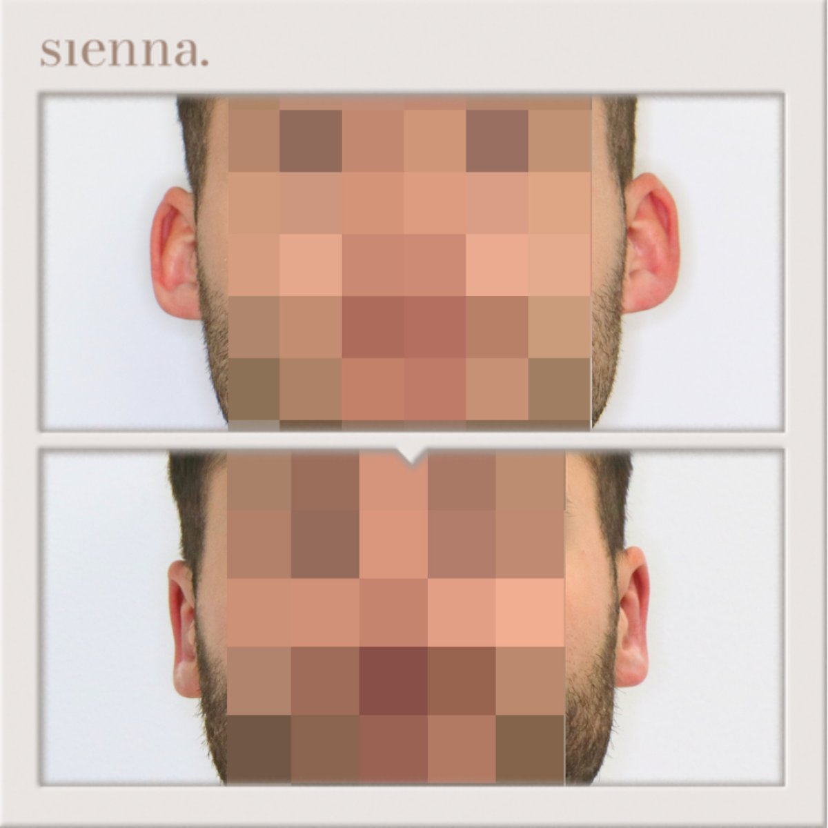 نتائج عملية تجميل الأذن قبل وبعد في Sienna Clinic، تحسين شكل الأذن وتناسقها