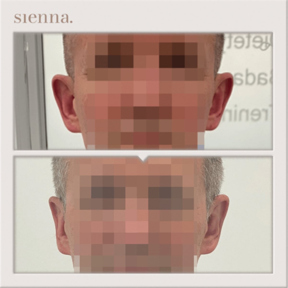 نتائج تجميل الأذن قبل وبعد في Sienna Clinic – تحسين شكل وأذن متناسقة