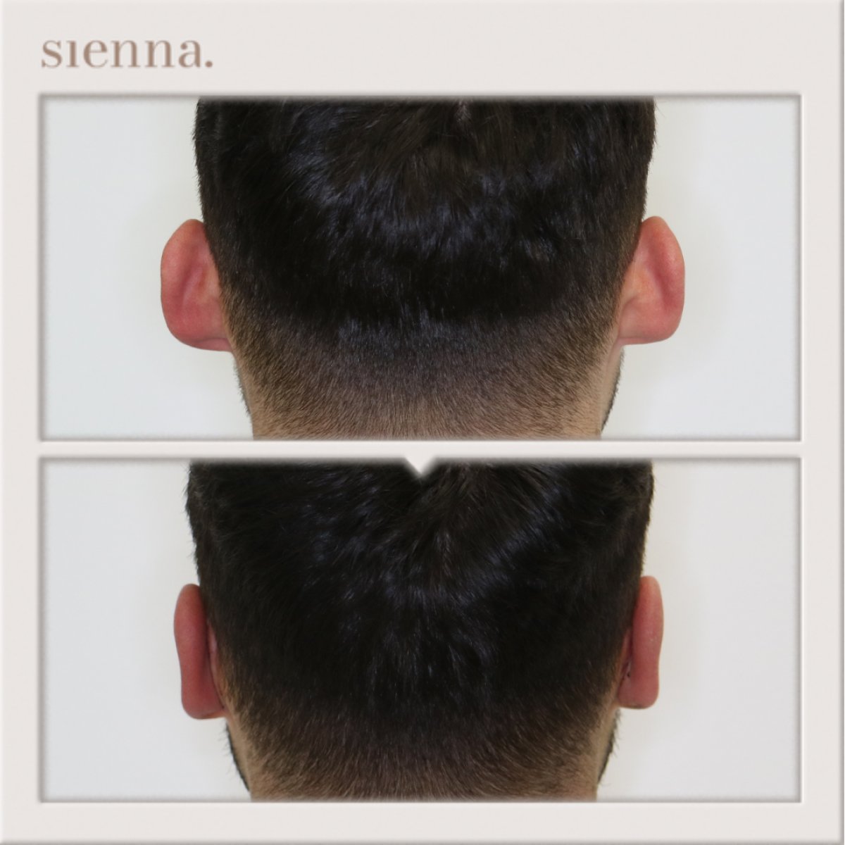 Before and after otoplasty at Sienna Clinic – ear reshaping surgery result for men