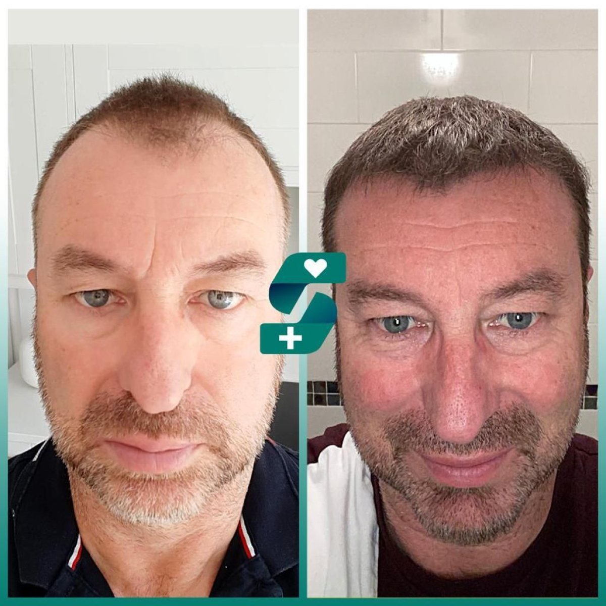 Before and after no shave hair transplant result at Soraca Med – improved hair density