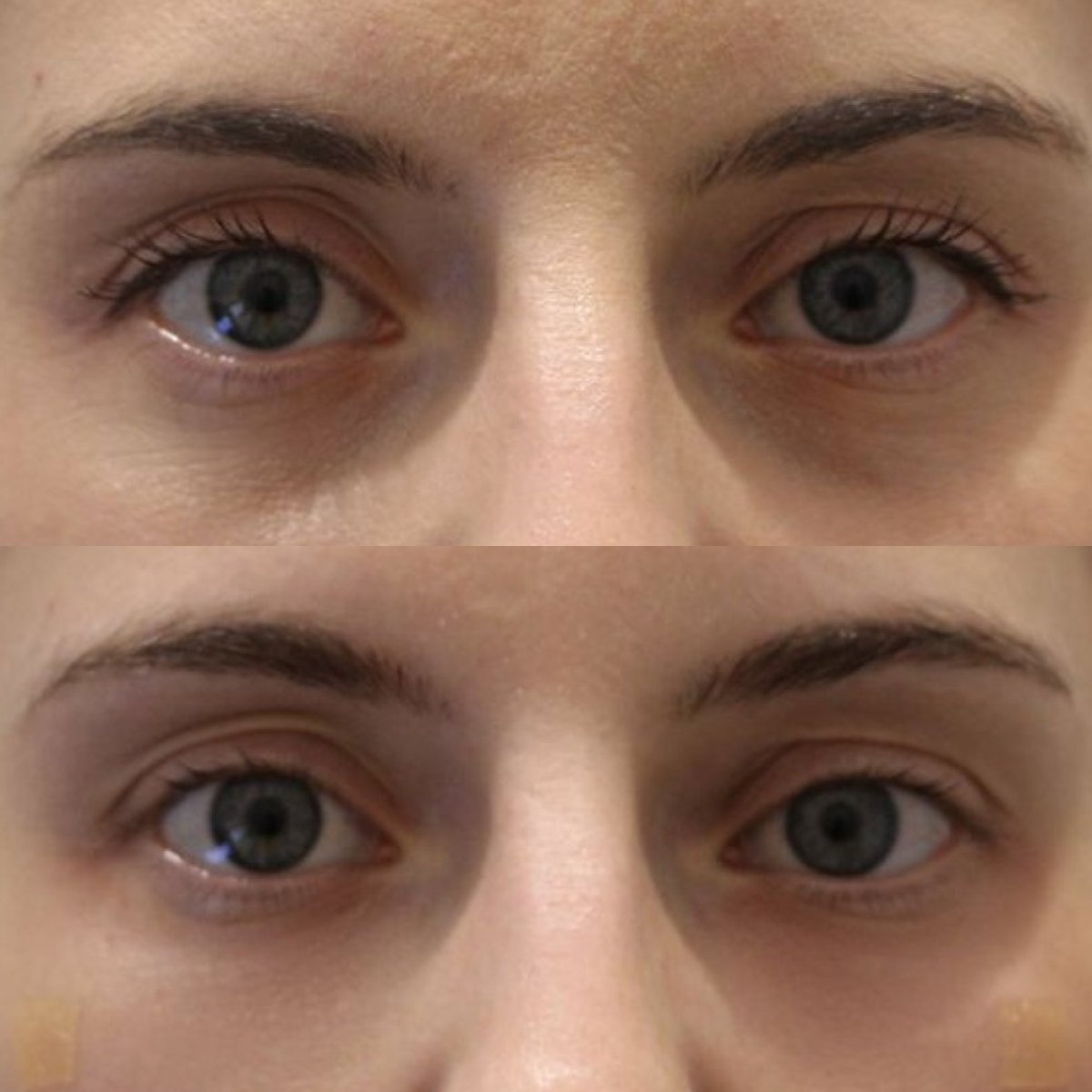 Before and after Botox injections at Forena Clinic, reduced wrinkles around eyes result
