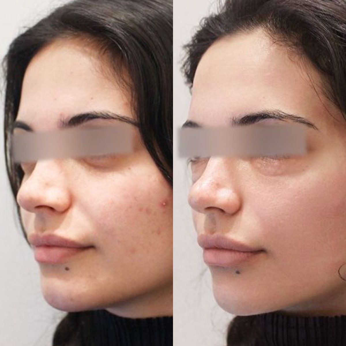 Before and after Botox injections at Forena Clinic, smoother skin and reduced wrinkles result
