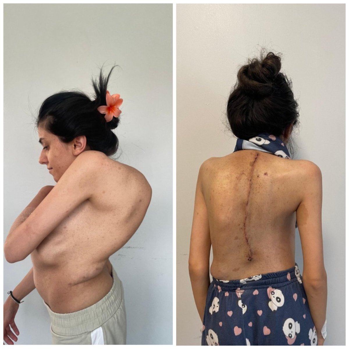 Before and after scoliosis surgery result at Central Hospital, visible spine alignment improvement