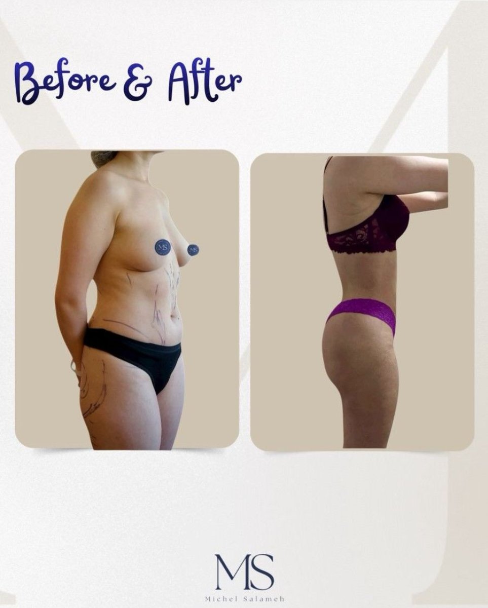 Resultados de lipescultura antes y después en Michel Salameh Clinic – mejor contorno corporal