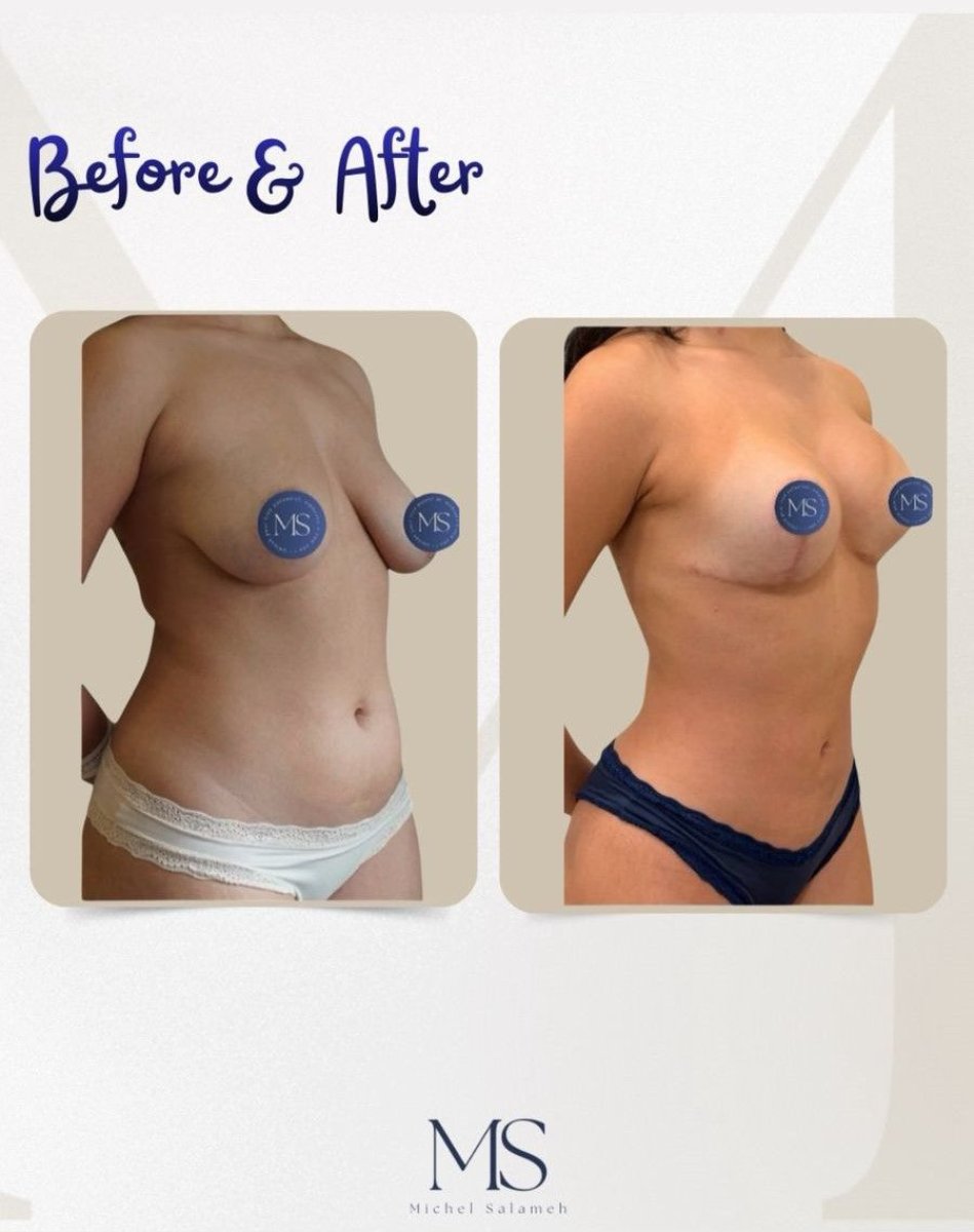 Before and after breast lift results at Michel Salameh Clinic, improved breast contour