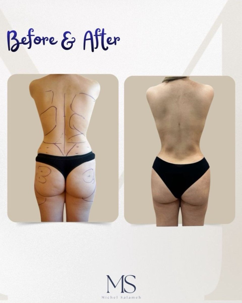 Résultats avant et après liposculpture à la clinique Michel Salameh – silhouette affinée