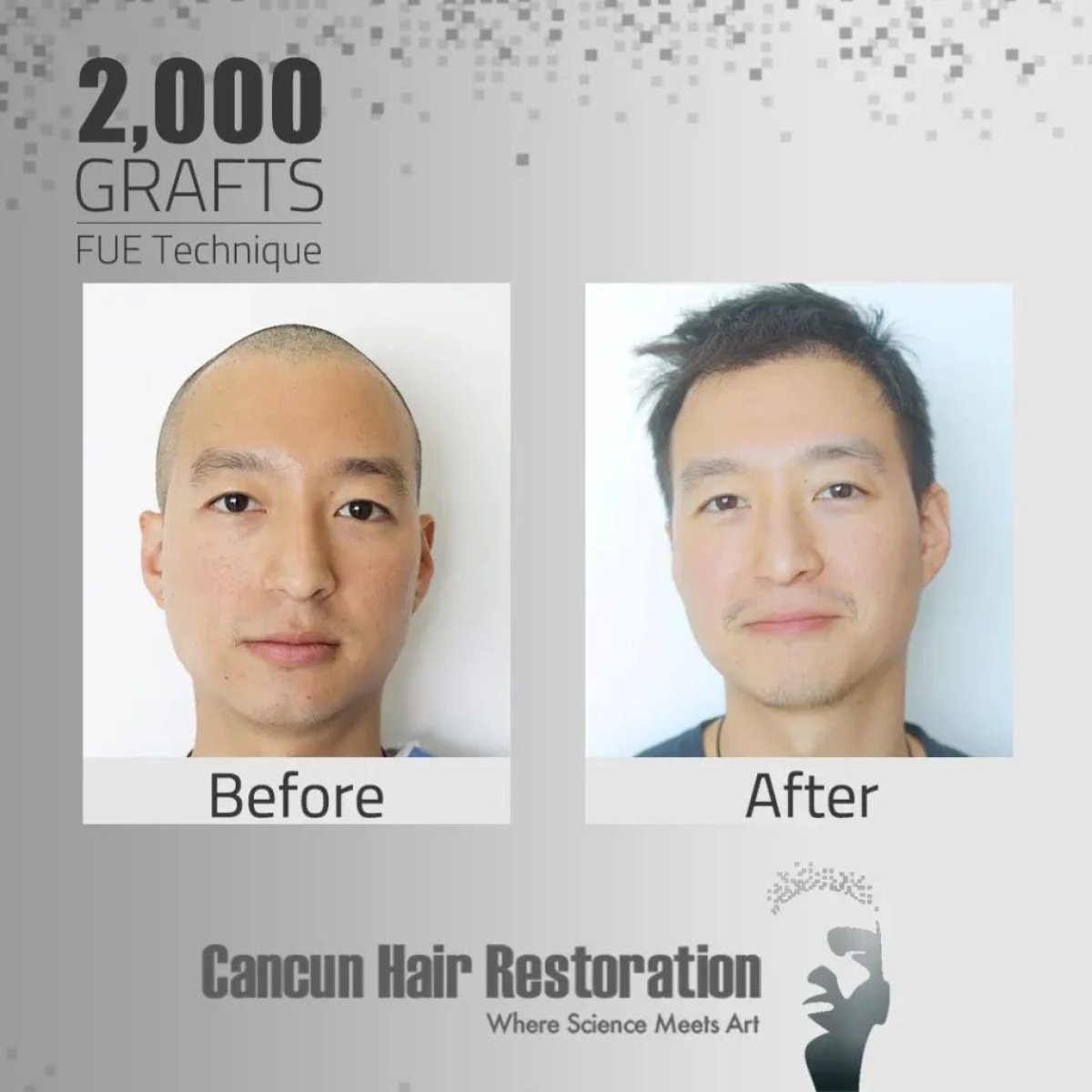 Antes y después de trasplante capilar FUE con 2000 injertos en Cancun Hair Restoration, resultados