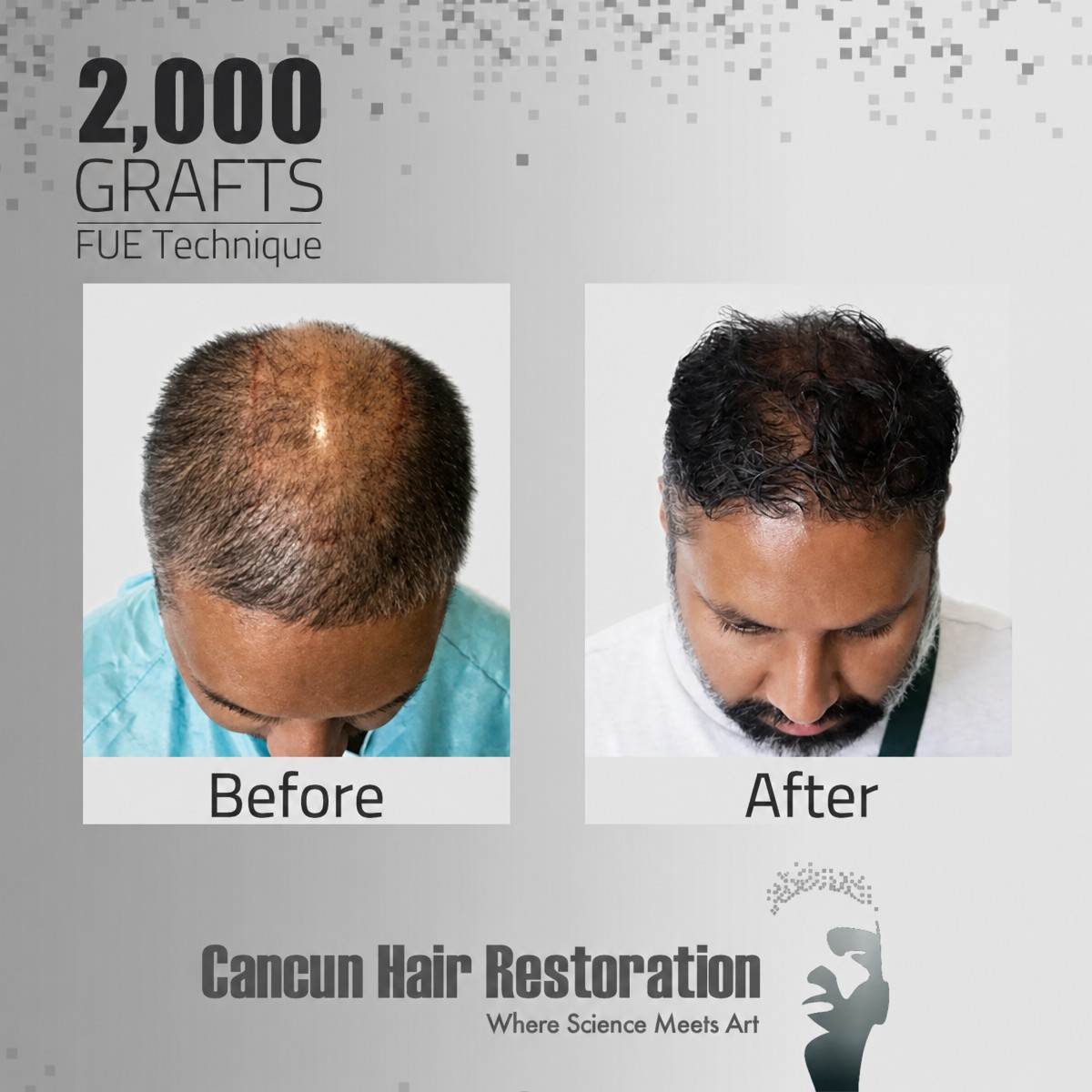 Before and after FUE hair transplant with 3,000 grafts at Cancun Hair Restoration results