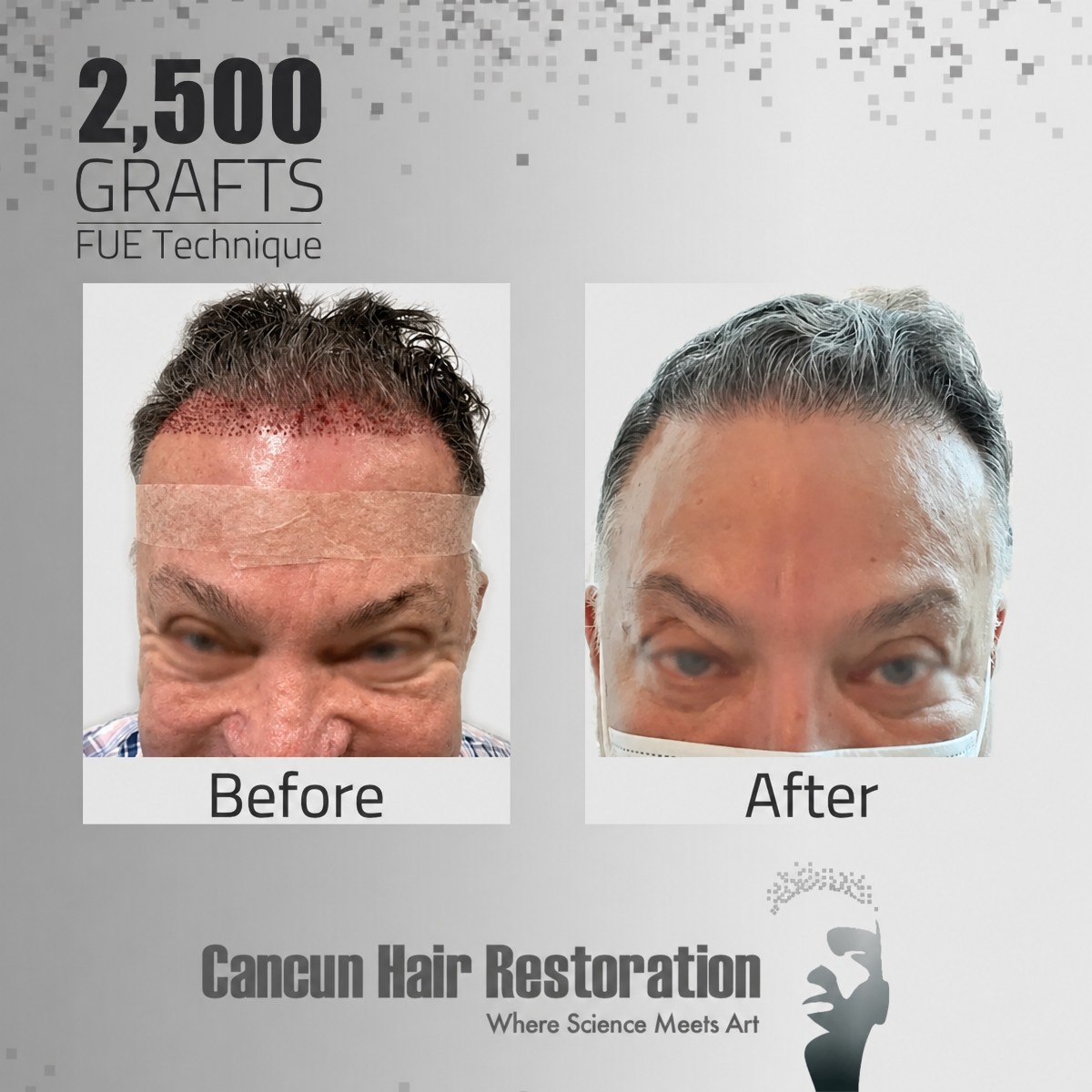 FUE hair transplant before and after results at Cancun Hair Restoration, 2,500 grafts procedure