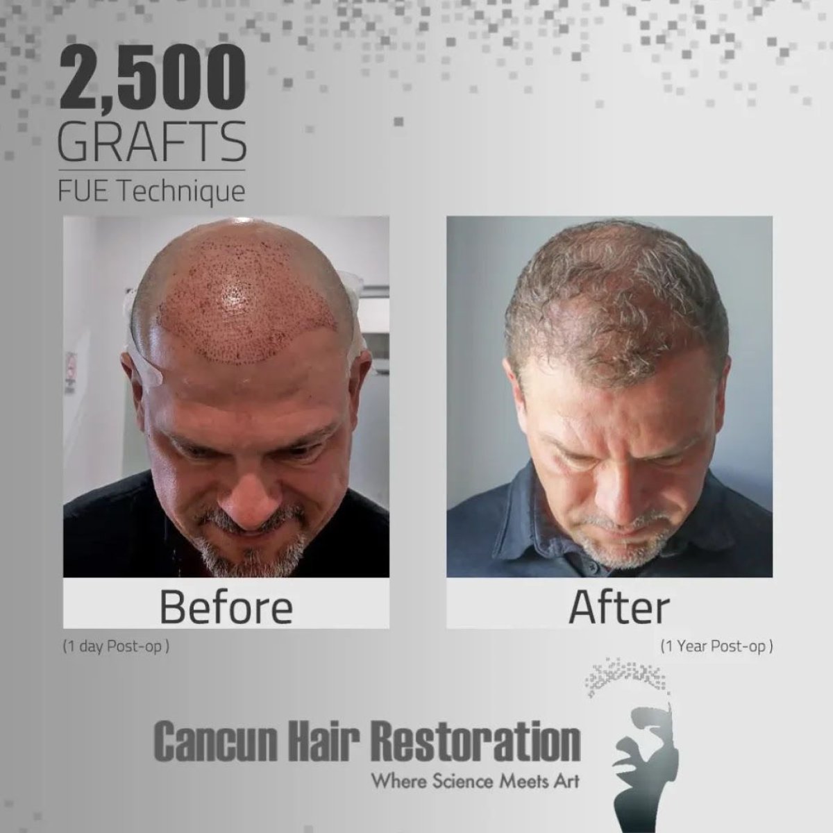 نتيجة زراعة الشعر FUE بـ2500 طعم في Cancun Hair Restoration قبل وبعد