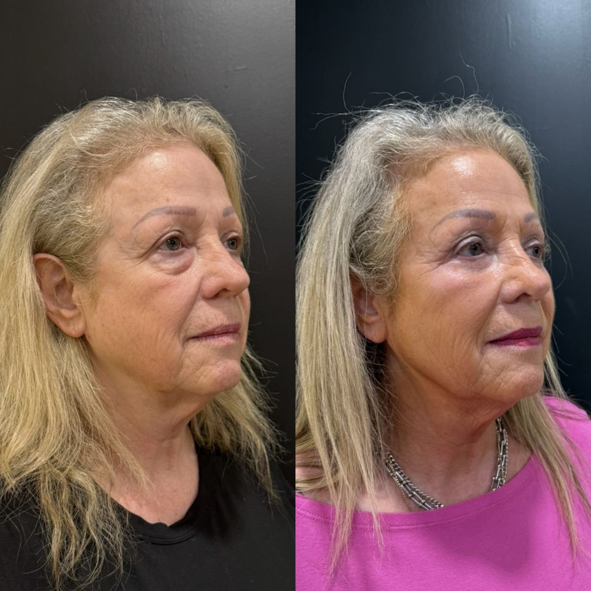 Before and after lower eyelid blepharoplasty results at Dr. Alexandro Aguilera - Plastic Surgery