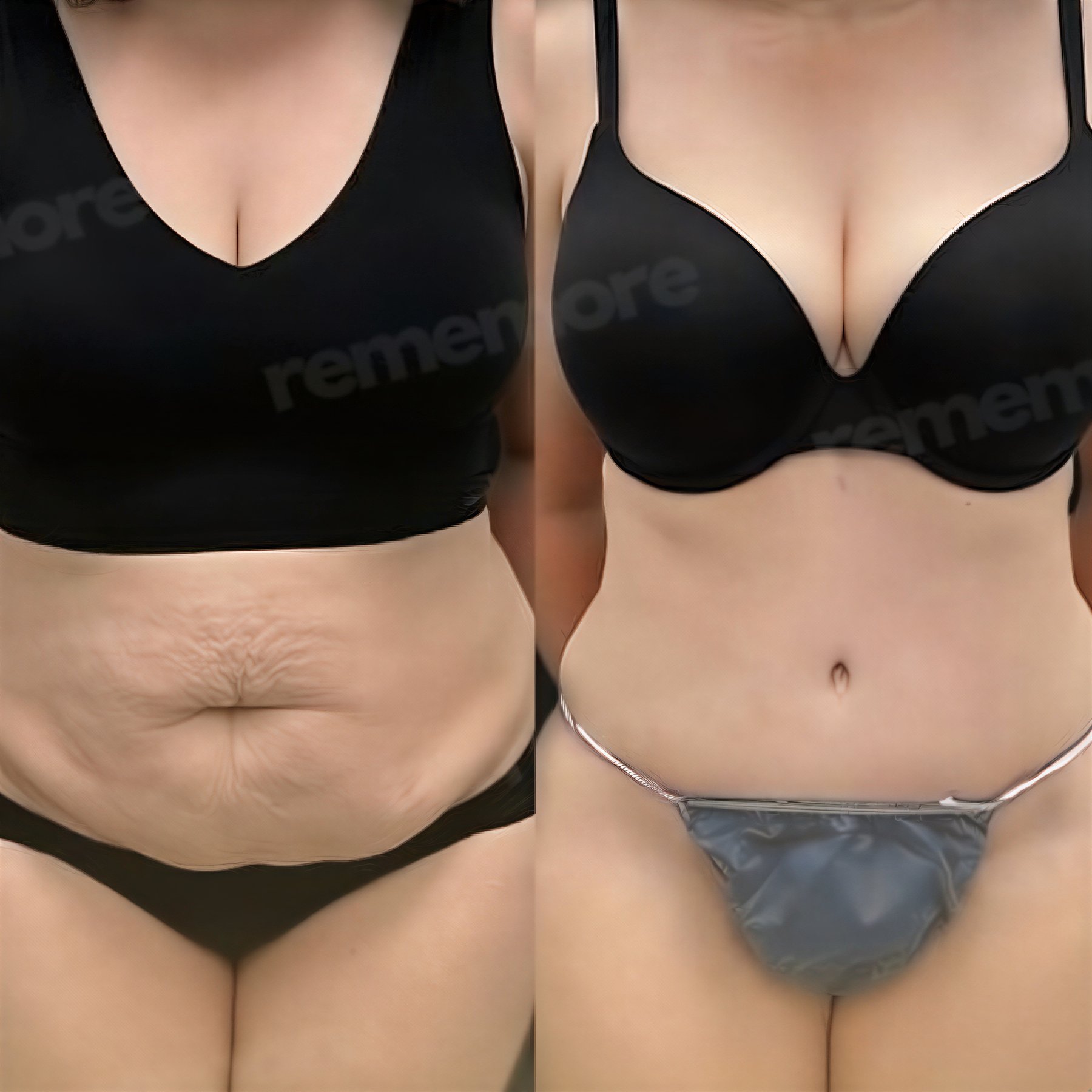 Resultados de abdominoplastia y liposucción antes y después en Memorial Ankara Hospital, abdomen plano