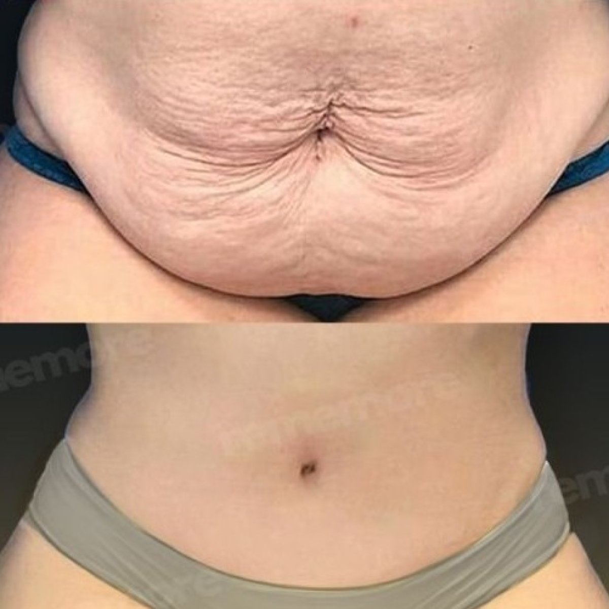 Resultados de abdominoplastia y liposucción antes y después en Memorial Ankara Hospital, abdomen plano