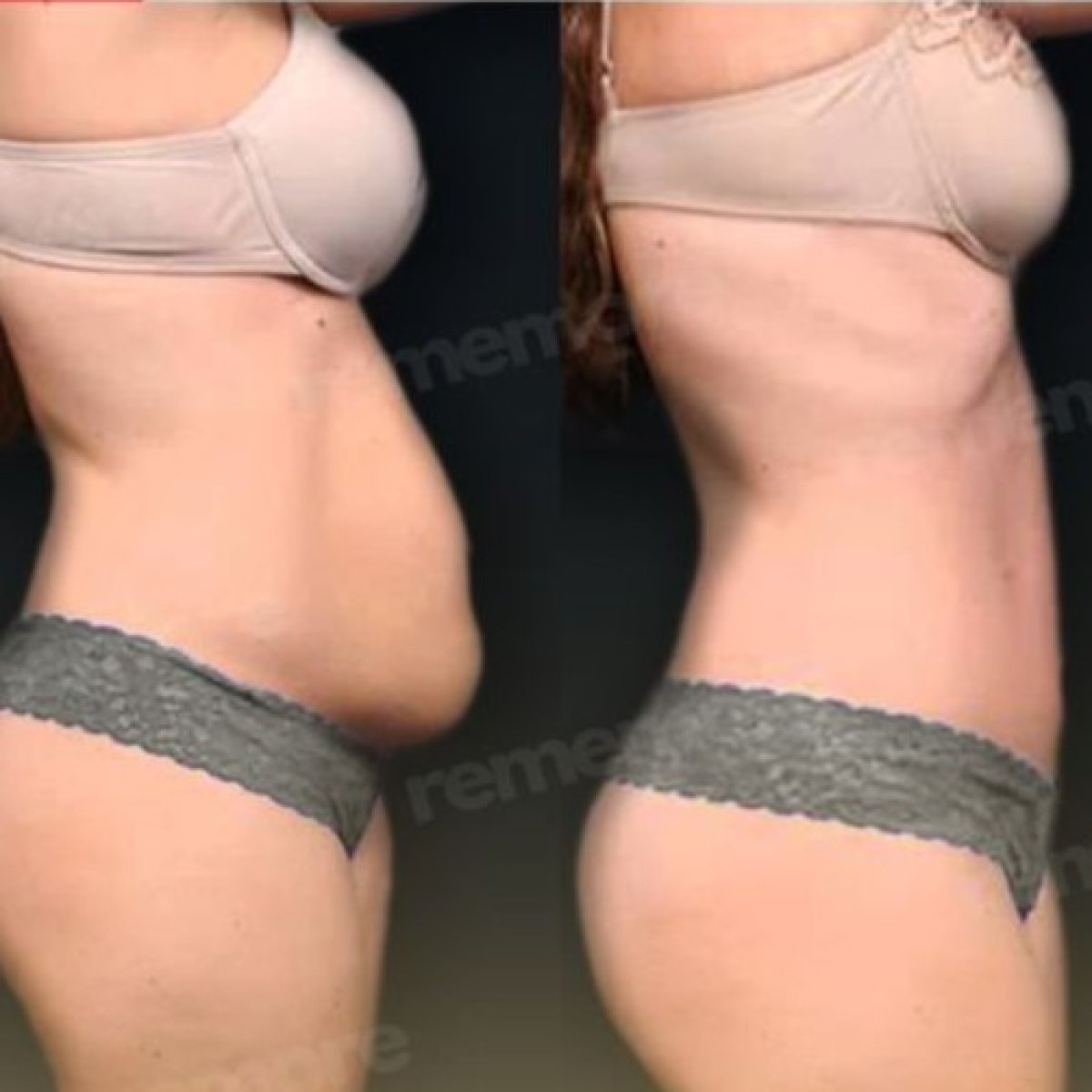 Resultados de abdominoplastia y liposucción antes y después en Memorial Ankara Hospital, abdomen plano