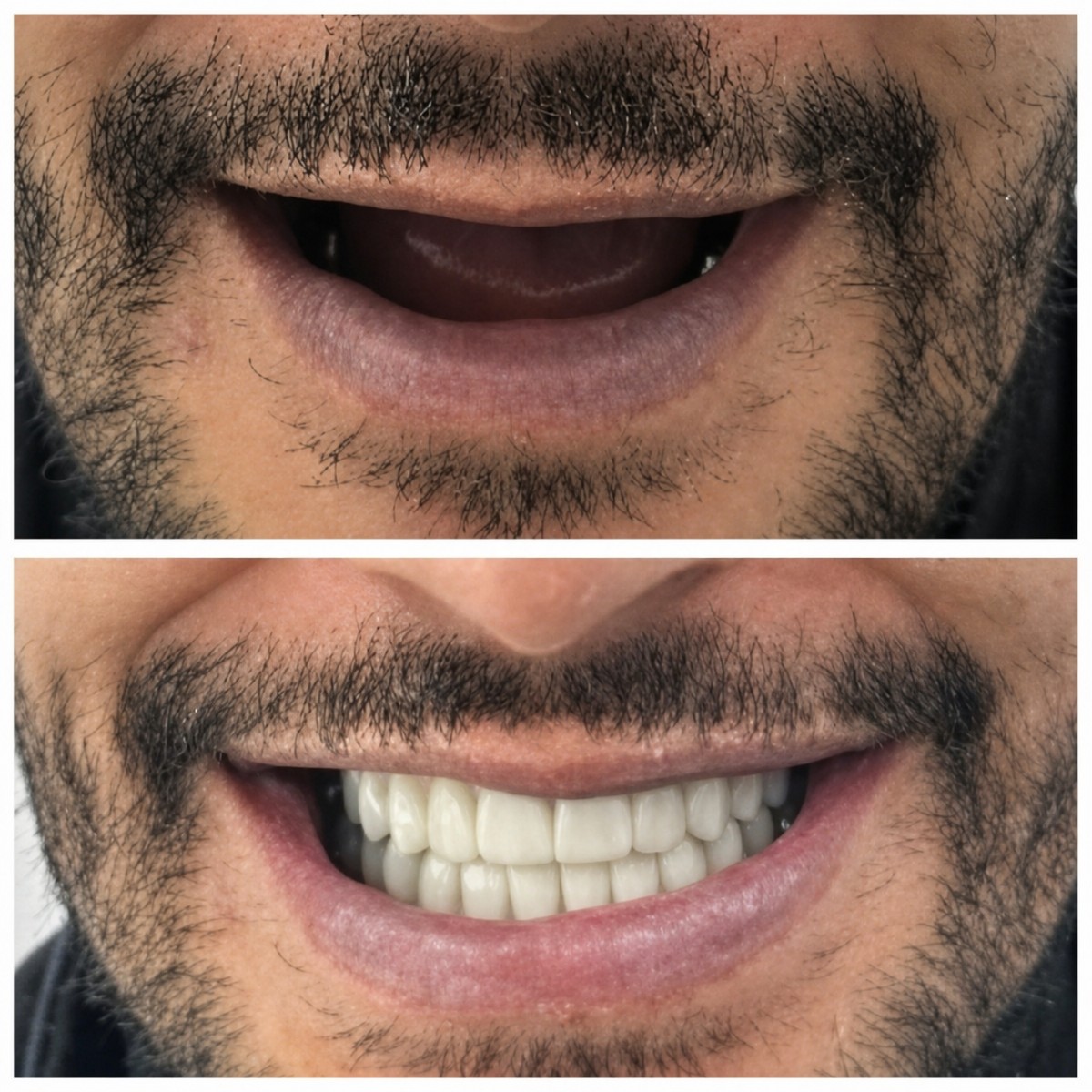 Before and after All-on-6 dental implants result at Santa Caterina Clinic, smile restoration